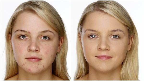 Tips to Cover Acne with Face Makeup