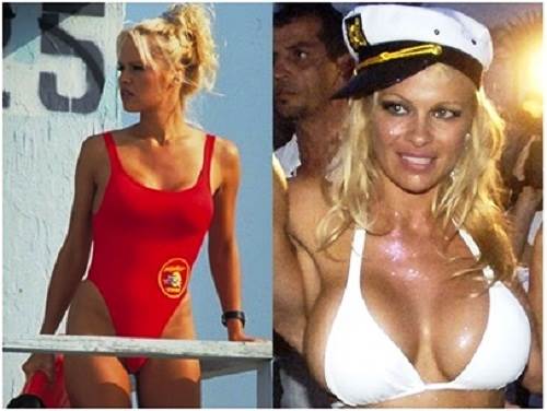 Pamela Anderson plastic surgery flops