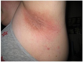 Underarm-Rashes