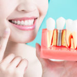 A Look At Dental Implants