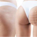 5 Things To Know Before Considering A Brazilian Butt Lift